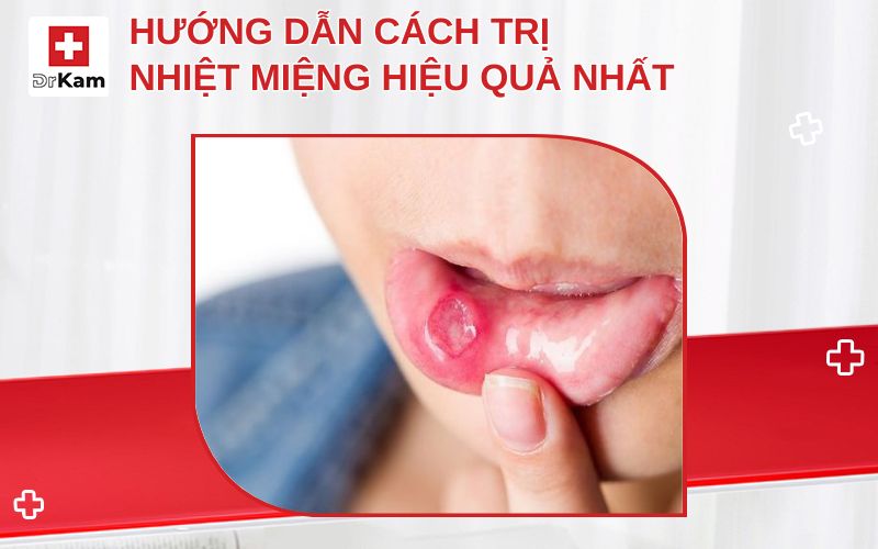 cach tri nhiet mieng hieu qua nhat thumbnail