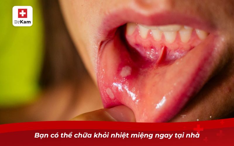 Cách chữa nhiệt miệng tại nhà đơn giản hiệu quả 4 Bạn có thể chữa khỏi nhiệt miệng ngay tại nhà