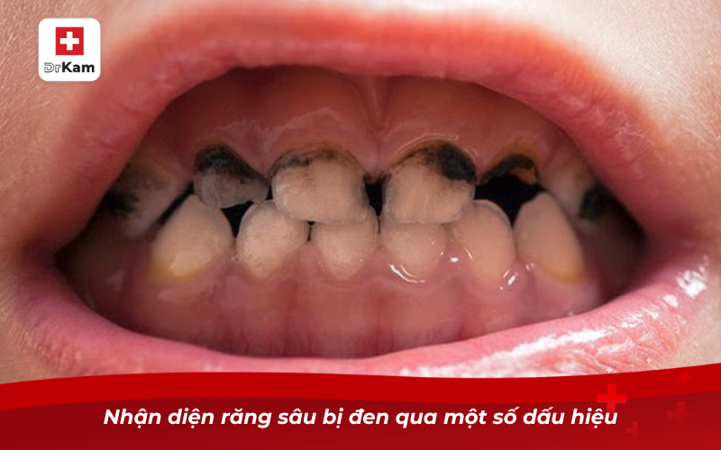 Chữa răng sâu bị đen: Nguyên nhân và cách điều trị hiệu quả 7 Nhận diện răng sâu bị đen qua một số dấu hiệu