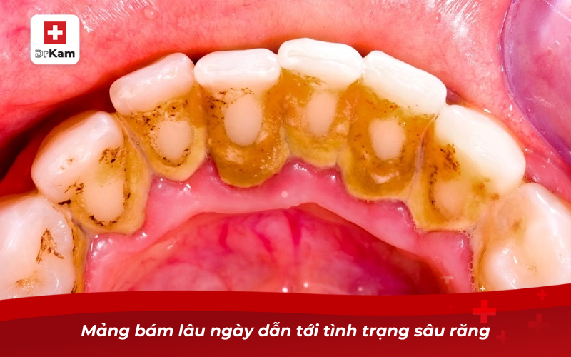 Chữa răng sâu bị đen: Nguyên nhân và cách điều trị hiệu quả 8 Mảng bám lâu ngày dẫn tới tình trạng sâu răng