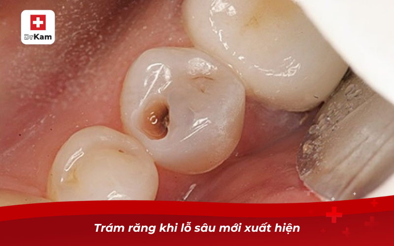 Chữa răng sâu bị đen: Nguyên nhân và cách điều trị hiệu quả 10 Trám răng khi lỗ sâu mới xuất hiện