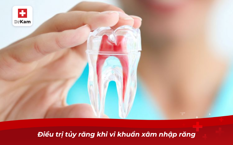 Chữa răng sâu bị đen: Nguyên nhân và cách điều trị hiệu quả 11 Điều trị tủy răng khi vi khuẩn xâm nhập răng