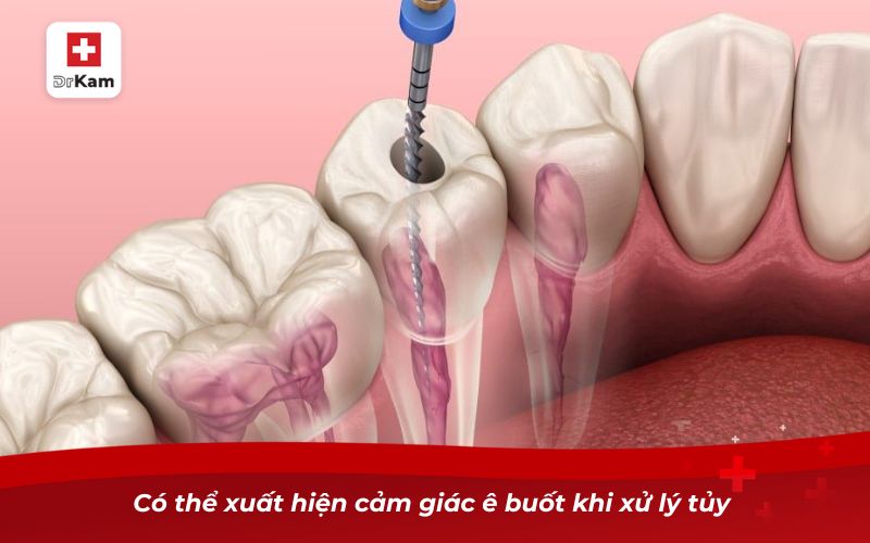 Có thể xuất hiện cảm giác ê buốt khi xử lý tủy 