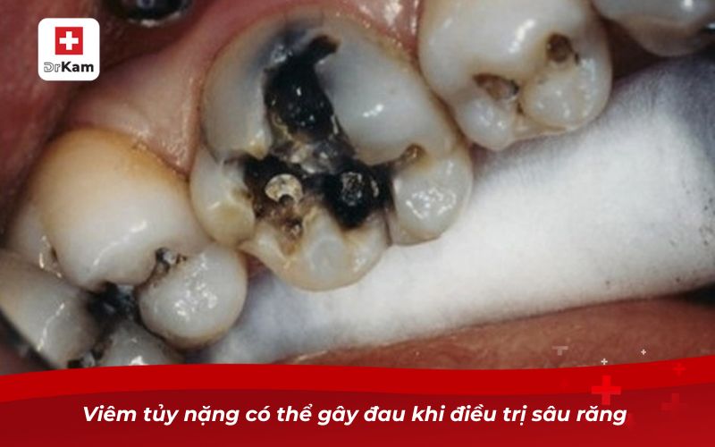 Viêm tủy nặng có thể gây đau khi điều trị sâu răng 