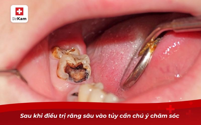 Sau khi điều trị răng sâu vào tủy cần chú ý chăm sóc 