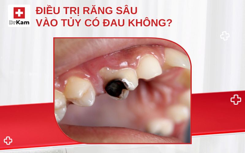 dieu tri rang sau vao tuy co dau khong thumbnail
