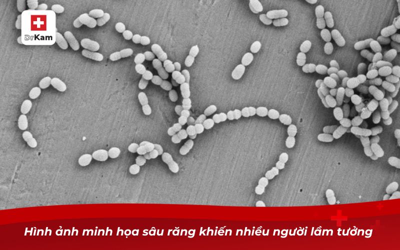 Hình ảnh con sâu răng – Sự thật và nguyên nhân sâu răng 7 Hình ảnh minh họa sâu răng khiến nhiều người lầm tưởng