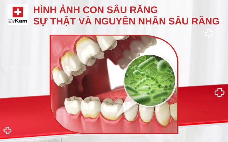 hinh anh con sau rang thumbnail