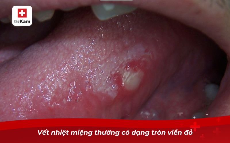 Vết nhiệt miệng thường có dạng tròn viền đỏ