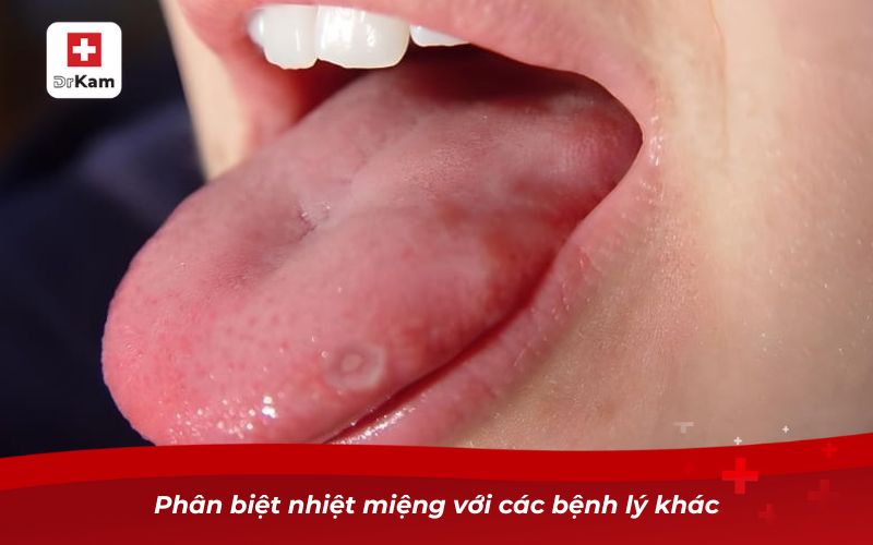 Phân biệt nhiệt miệng với các bệnh lý khác