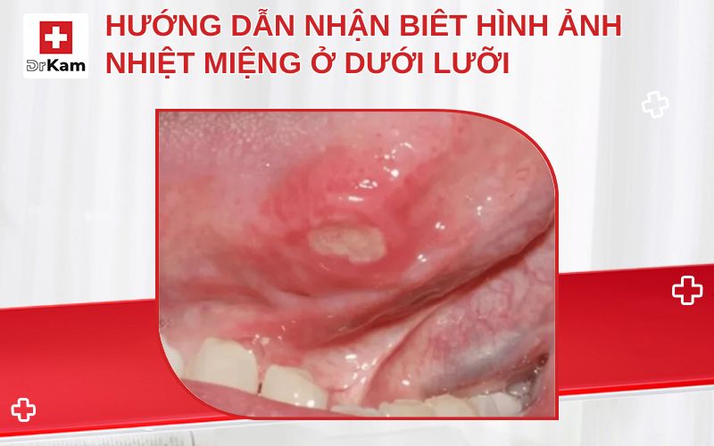 hinh anh nhiet mieng duoi luoi thumbnail