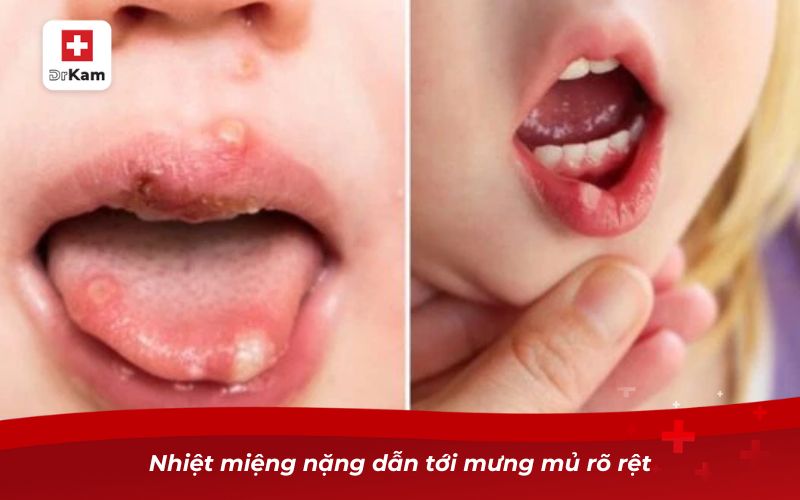 Nhiệt miệng nặng dẫn tới mưng mủ rõ rệt