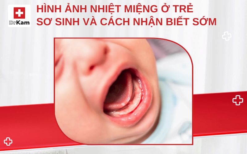 hinh anh nhiet mieng o tre so sinh thumbnail