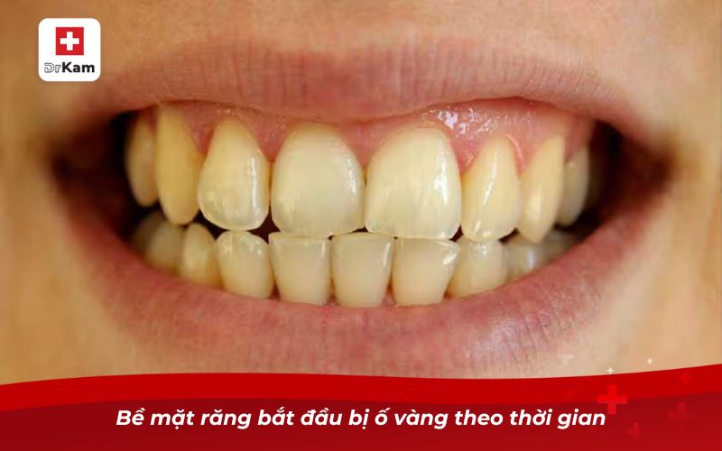 Hướng dẫn nhận biết hình ảnh răng sâu qua từng giai đoạn 6 Bề mặt răng bắt đầu bị ố vàng theo thời gian