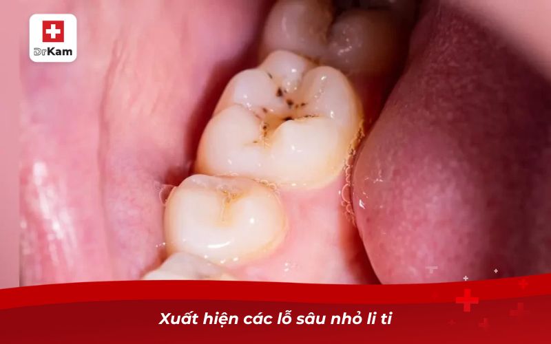 Hướng dẫn nhận biết hình ảnh răng sâu qua từng giai đoạn 7 Xuất hiện các lỗ sâu nhỏ li ti