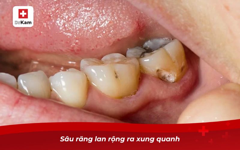Hướng dẫn nhận biết hình ảnh răng sâu qua từng giai đoạn 8 Sâu răng lan rộng ra xung quanh