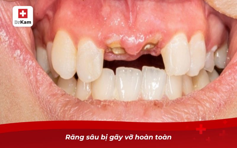 Hướng dẫn nhận biết hình ảnh răng sâu qua từng giai đoạn 9 Răng sâu bị gãy vỡ hoàn toàn