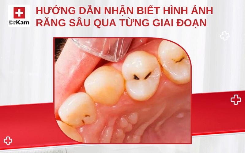 hinh anh rang sau thumbnail