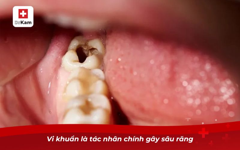 Nguyên nhân gây sâu răng và những điều bạn cần biết 6 Vi khuẩn là tác nhân chính gây sâu răng