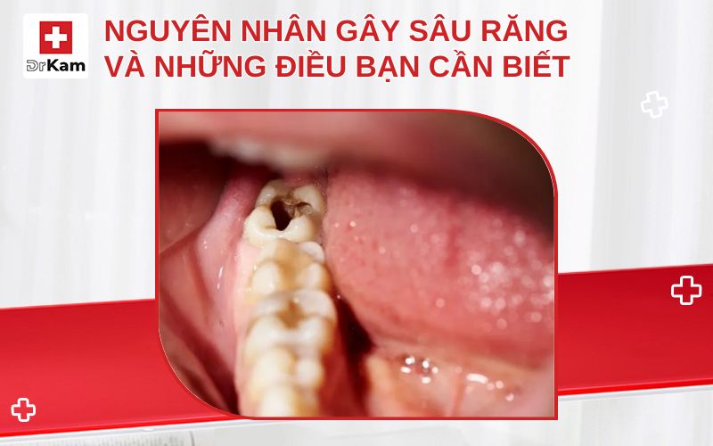 nguyen nhan gay sau rang thumbnail