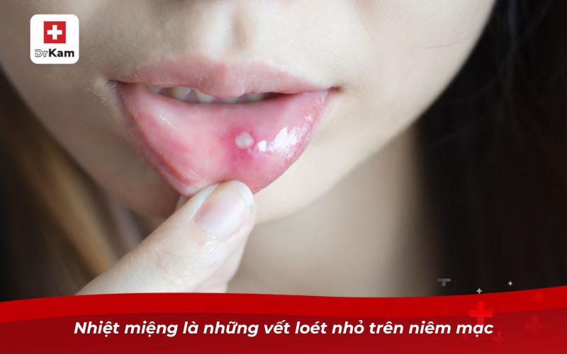 Nguyên nhân hay bị nhiệt miệng và những điều cần lưu ý 6 Nhiệt miệng là những vết loét nhỏ trên niêm mạc