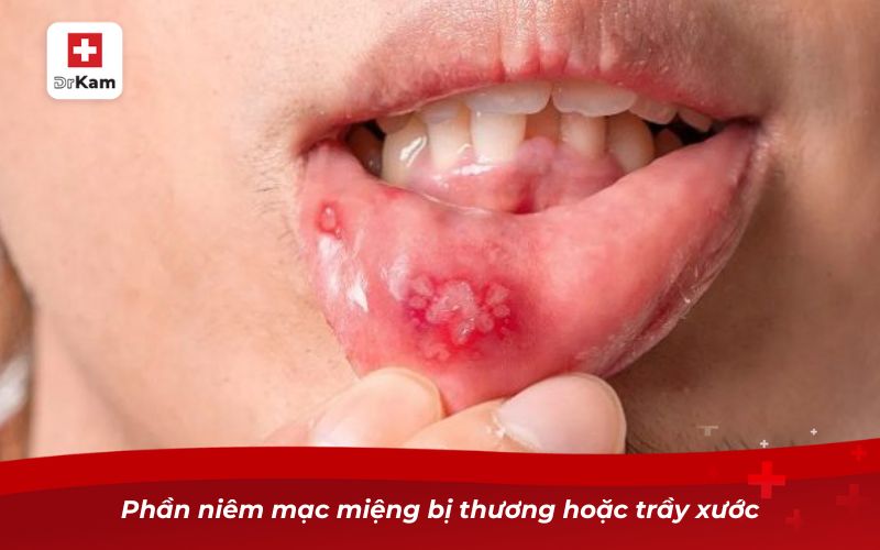 Nguyên nhân hay bị nhiệt miệng và những điều cần lưu ý 8 Phần niêm mạc miệng bị thương hoặc trầy xước