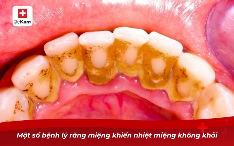 Nhiệt miệng bao lâu thì khỏi? Nguyên nhân và lưu ý cụ thể 11 Một số bệnh lý răng miệng khiến nhiệt miệng không khỏi