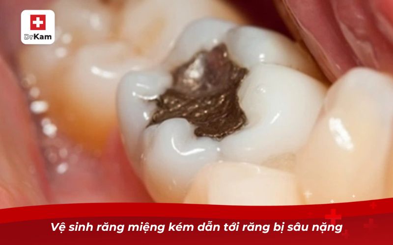 Răng bị sâu lỗ to phải làm sao? Giải pháp dứt điểm hiệu quả 7 Vệ sinh răng miệng kém dẫn tới răng bị sâu nặng