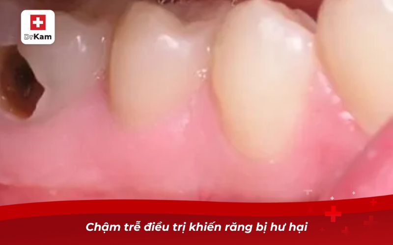 Răng bị sâu lỗ to phải làm sao? Giải pháp dứt điểm hiệu quả 8 Chậm trễ điều trị khiến răng bị hư hại