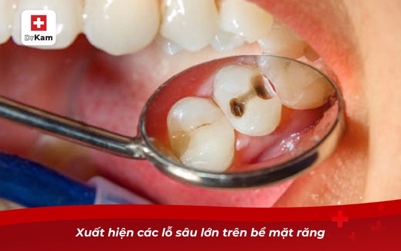 Răng bị sâu lỗ to phải làm sao? Giải pháp dứt điểm hiệu quả 9 Xuất hiện các lỗ sâu lớn trên bề mặt răng