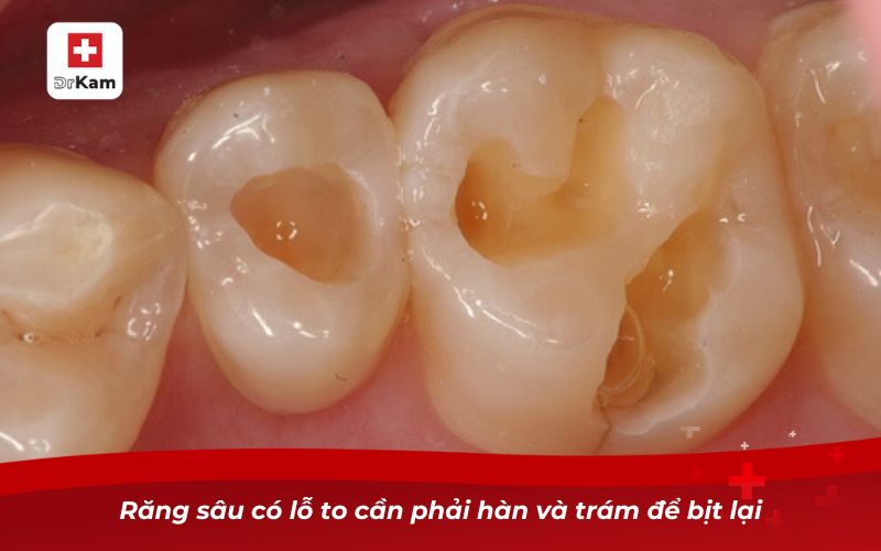 Răng bị sâu lỗ to phải làm sao? Giải pháp dứt điểm hiệu quả 10 Răng sâu có lỗ to cần phải hàn và trám để bịt lại