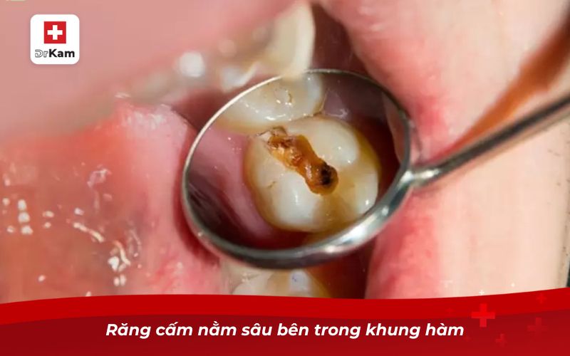Răng Cấm Bị Sâu - Nguyên Nhân, Triệu Chứng Và Cách Xử Lý 9 Răng cấm nằm sâu bên trong khung hàm