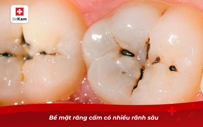 Răng Cấm Bị Sâu - Nguyên Nhân, Triệu Chứng Và Cách Xử Lý 12 Bề mặt răng cấm có nhiều rãnh sâu