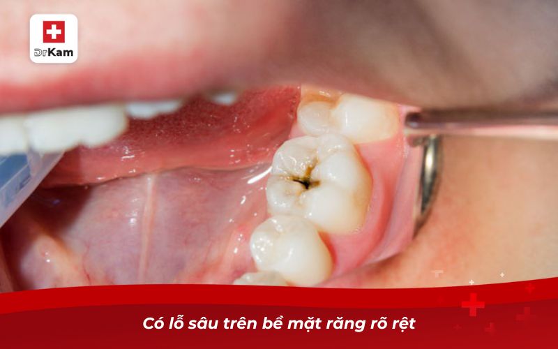 Răng Cấm Bị Sâu - Nguyên Nhân, Triệu Chứng Và Cách Xử Lý 13 Có lỗ sâu trên bề mặt răng rõ rệt