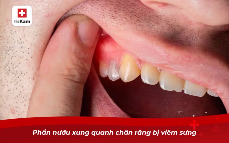 Răng Cấm Bị Sâu - Nguyên Nhân, Triệu Chứng Và Cách Xử Lý 14 Phần nướu xung quanh chân răng bị viêm sưng