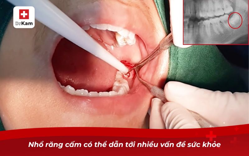 Răng Cấm Bị Sâu - Nguyên Nhân, Triệu Chứng Và Cách Xử Lý 15 Nhổ răng cấm có thể dẫn tới nhiều vấn đề sức khỏe