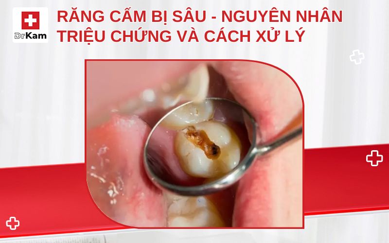 rang cam bi sau thumbnail