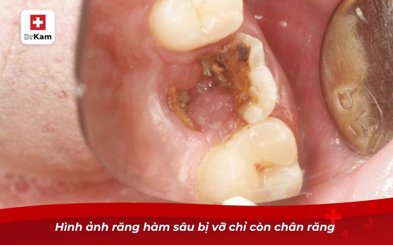 Răng hàm bị sâu chỉ còn chân răng và cách xử lý 7 Hình ảnh răng hàm sâu bị vỡ chỉ còn chân răng