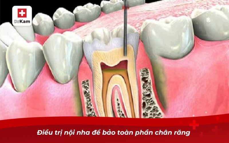 Răng hàm bị sâu chỉ còn chân răng và cách xử lý 8 Điều trị nội nha để bảo toàn phần chân răng