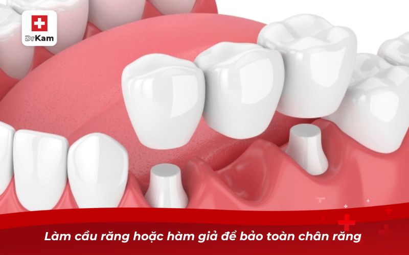 Răng hàm bị sâu chỉ còn chân răng và cách xử lý 9 Làm cầu răng hoặc hàm giả để bảo toàn chân răng