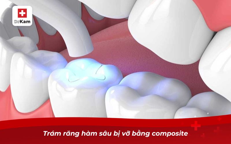Răng hàm bị sâu chỉ còn chân răng và cách xử lý 10 Trám răng hàm sâu bị vỡ bằng composite