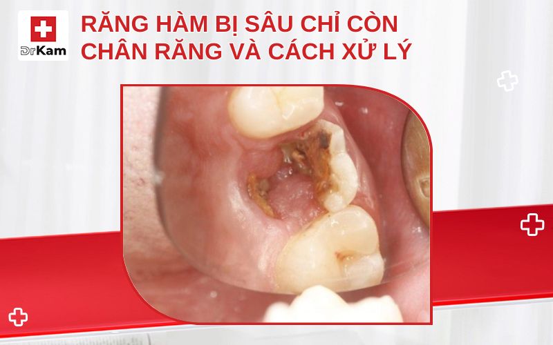 rang ham bi sau chi con chan rang thumbnail