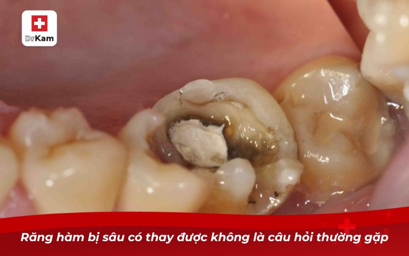 Răng hàm bị sâu có thay được không là câu hỏi thường gặp