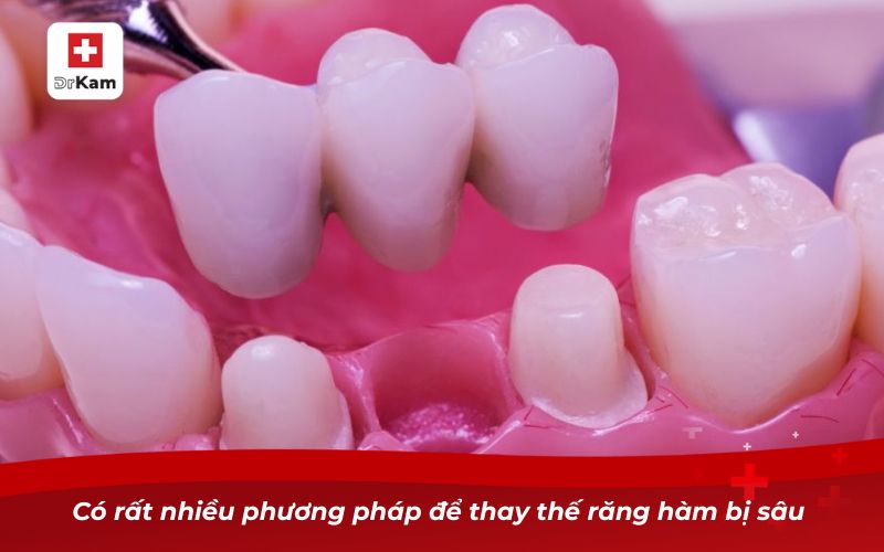 Có rất nhiều phương pháp để thay thế răng hàm bị sâu 