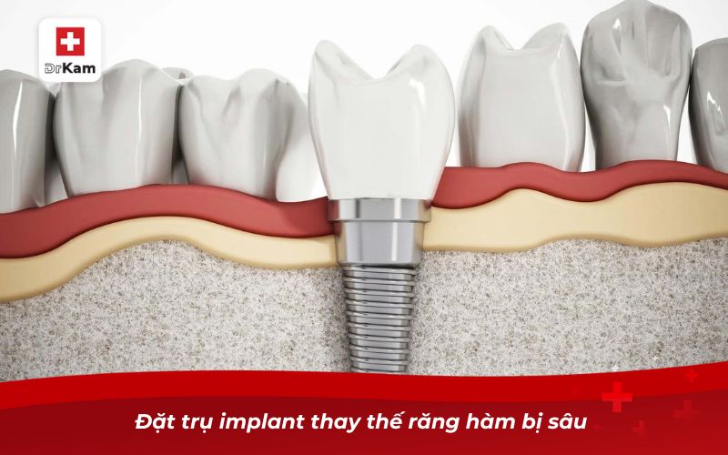 Đặt trụ implant thay thế răng hàm bị sâu 
