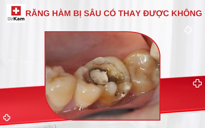 rang ham bi sau co thay duoc khong thumbnail