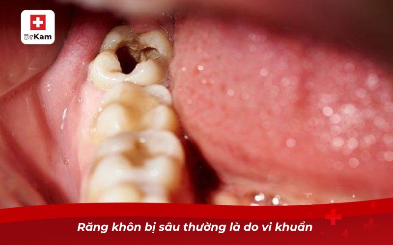 Răng khôn bị sâu đau nhức thì phải làm sao? 6 Răng khôn bị sâu thường là do vi khuẩn