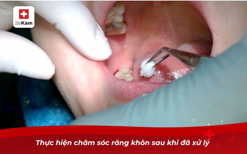 Răng khôn bị sâu đau nhức thì phải làm sao? 8 Thực hiện chăm sóc răng khôn sau khi đã xử lý