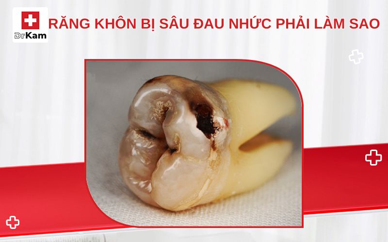 rang khon bi sau dau nhuc thumbnail 1