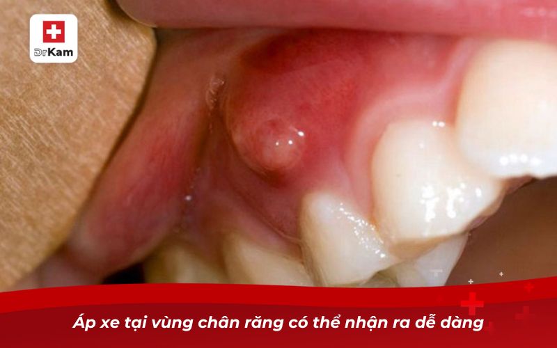 Răng không sâu nhưng bị nhức – Nguyên nhân và cách khắc phục 8 Áp xe tại vùng chân răng có thể nhận ra dễ dàng